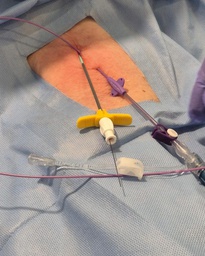 [85131700] MODULO 1 DIPLOMADO 4a GENERACIÓN "COMPETENCIAS AVANZADAS EN TERAPIA DE INFUSION Y ACCESOS VASCULARES"