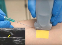[85131700] Modulo 6 Diplomado 3ª Generación – 2026 “Competencias avanzadas en Terapia de Infusión y Accesos Vasculares Aplicando la Ecografía como herramienta fundamental en la práctica clínica”