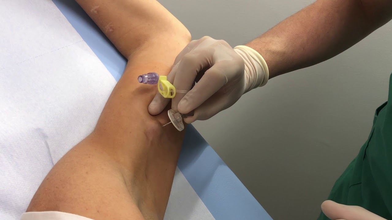 “Innovación en el Acceso Vascular: Técnica de Instalación del PICC-Port”