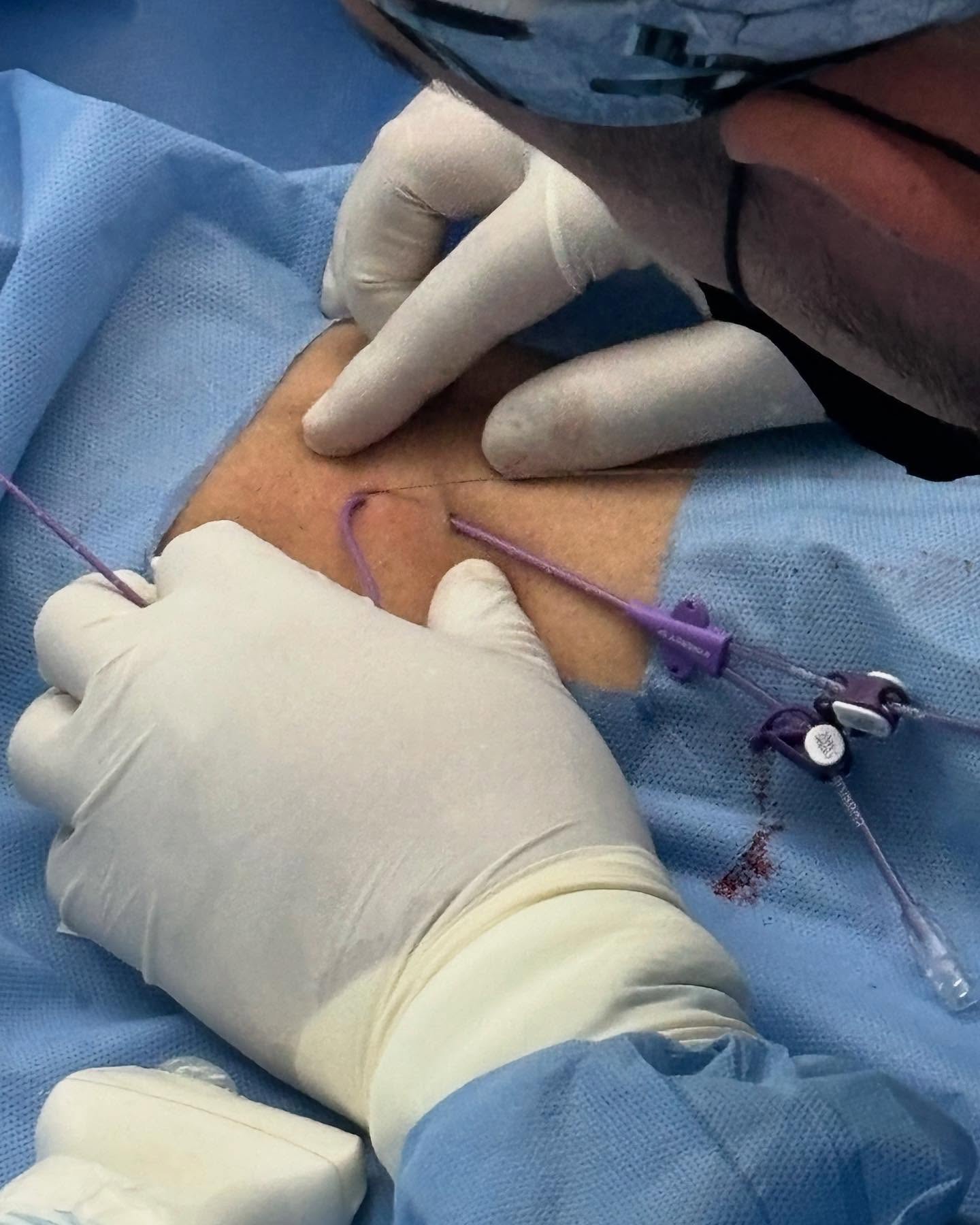 WEBINAR: Evaluación rápida del sitio de salida vascular y opciones de tunelización (RAVESTO)